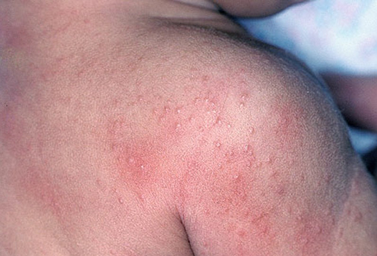 Antibiyotik Zehirlenmesi Belirtileri ve Tedavisi